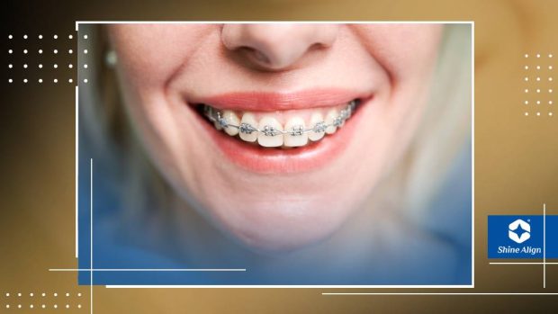 ارتودنسی ثابت روشی برای ترتیب دندان‌ها