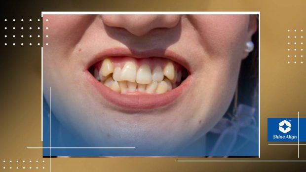 علت قالب گیری دندان ارتودنسی