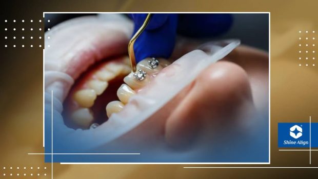 روش های بلیچینگ ( سفید کردن دندان) بعد از ارتودنسی