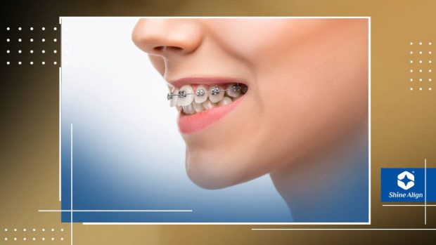 اصلاح مشکلات دندانی با ارتودنسی