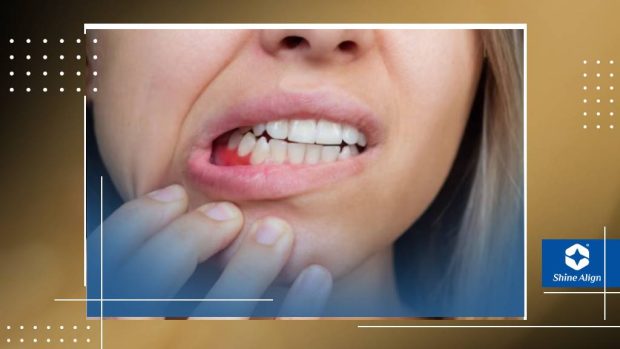 حساسیت در روند جرمگیری دندان