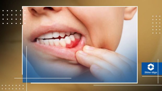 حساسیت دندان با بلیچینگ