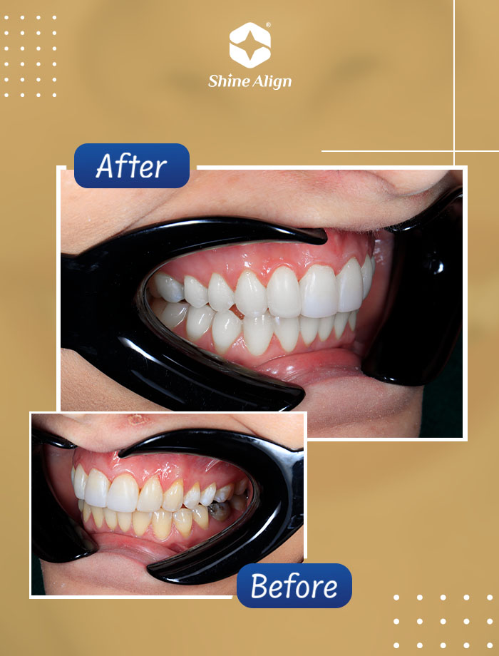 نمونه کار بلیچینگ دندان ۲