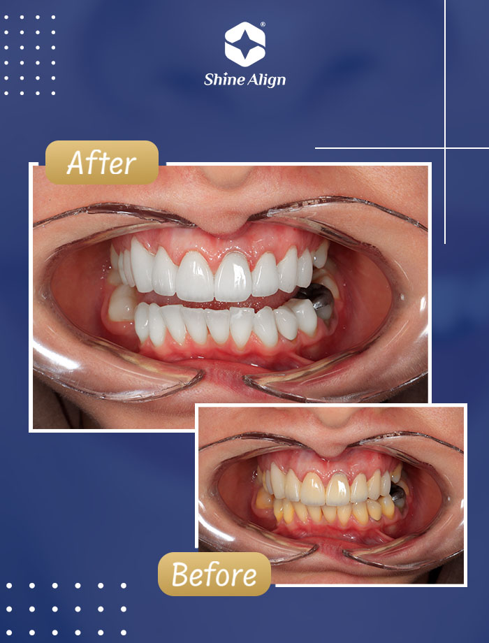 نمونه بلیچینگ دندان ۳